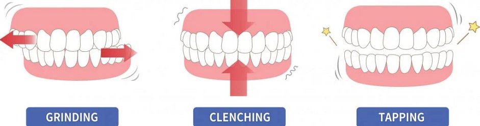 BRUXISM-RELATED PAIN (JAW CLENCHING/GRINDING) - ForthWorthHeadNeckandJaw